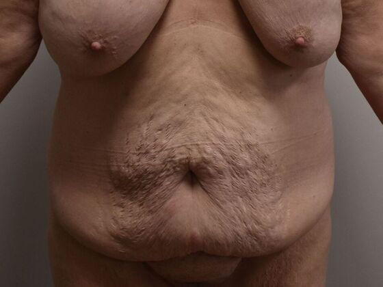 Tummy Tuck (Abdominoplasty) Case 539 - Before