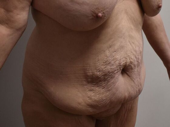 Tummy Tuck (Abdominoplasty): Case 539 - Before