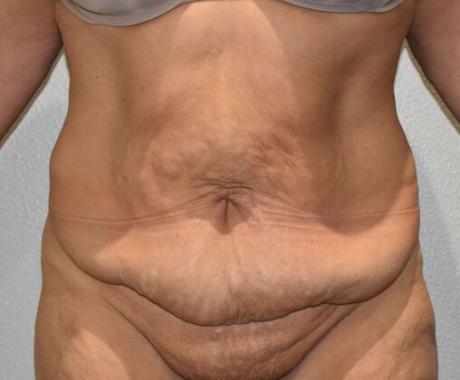 Massive Weight Loss  Case 178 - Before