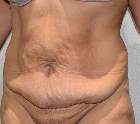 Massive Weight Loss : Case 178 - Before