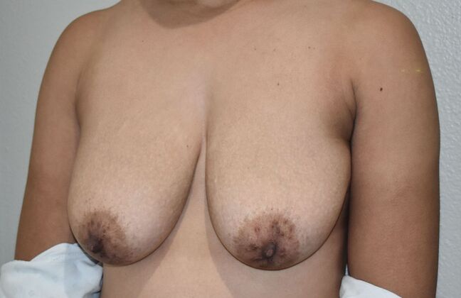 Breast Augmentation w/ Lift: Case 597 - Before