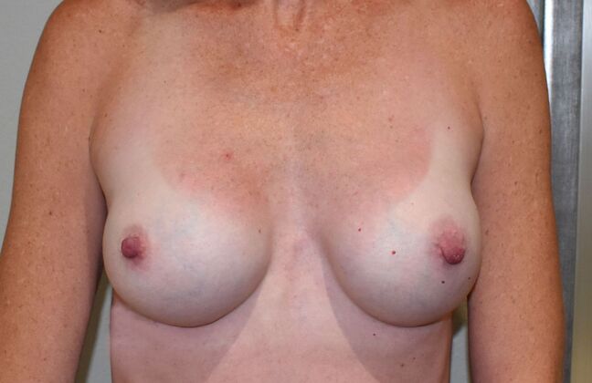 Breast Augmentation Case 479 - After