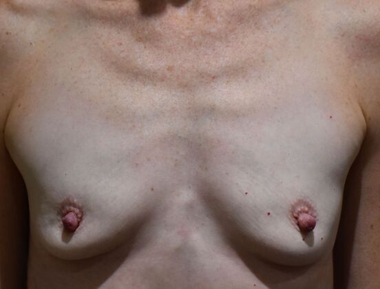 Breast Augmentation Case 479 - Before
