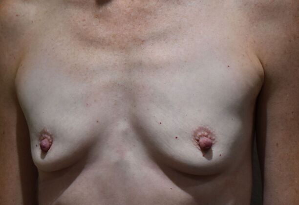 Breast Augmentation: Case 479 - Before