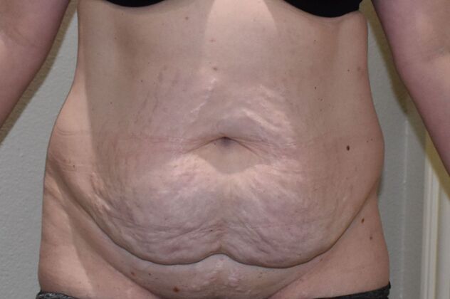 Tummy Tuck (Abdominoplasty) Case 541 - Before