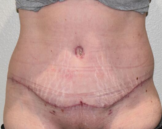 Tummy Tuck (Abdominoplasty) Case 541 - After