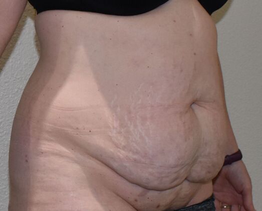 Tummy Tuck (Abdominoplasty): Case 541 - Before