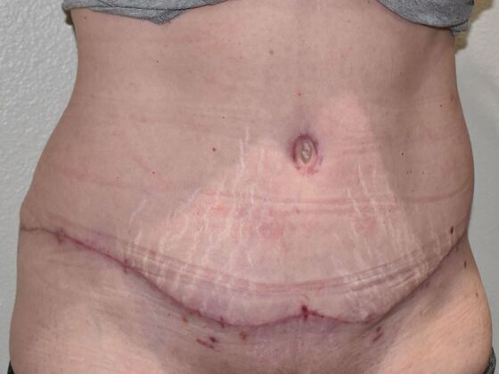 Tummy Tuck (Abdominoplasty): Case 541 - After
