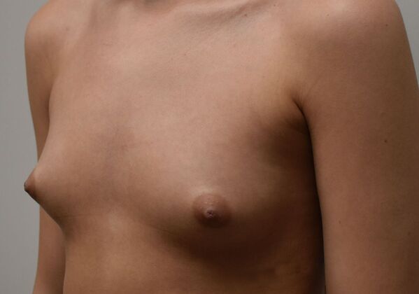 Breast Augmentation: Case 792 - Before