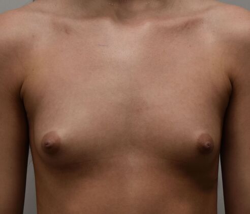 Breast Augmentation w/ Lift Case 598 - Before