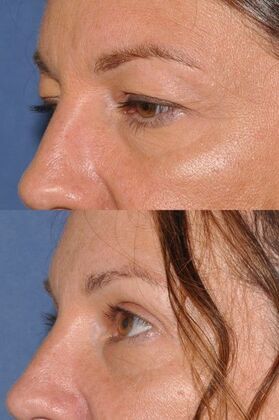 Eyelid Surgery: Upper lids before and after - Before