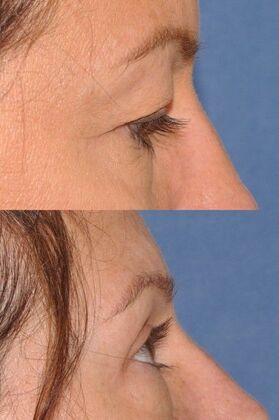 Eyelid Surgery: Upper lids before and after - Before