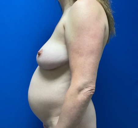 Mommy Makeover: Case 39 - Before