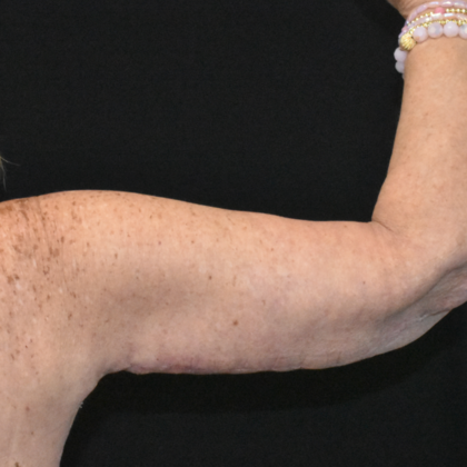 Brachioplasty: Case 6 - After