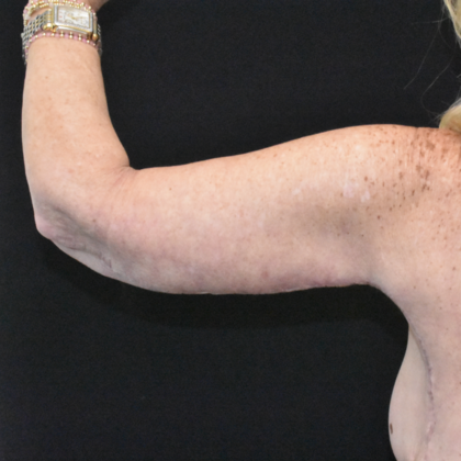Brachioplasty: Case 6 - After