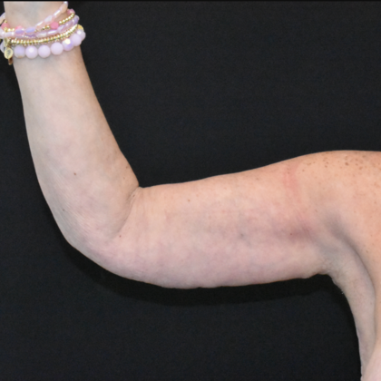 Brachioplasty: Case 6 - After
