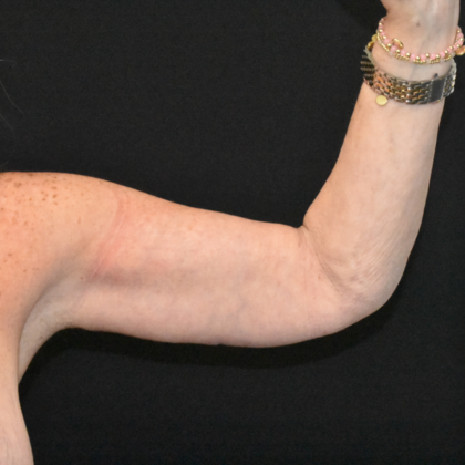 Brachioplasty Case 6 - After