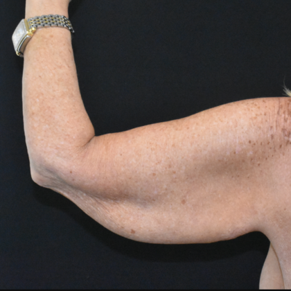 Brachioplasty: Case 6 - Before