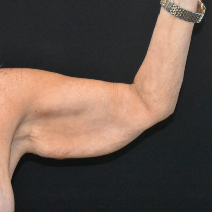 Brachioplasty Case 6 - Before