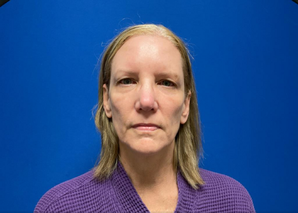 Facelift Case 19 - Before