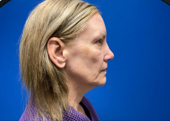 Facelift: Case 19 - Before