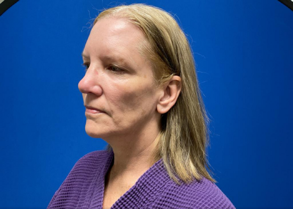 Facelift: Case 19 - Before