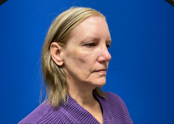 Facelift: Case 19 - Before