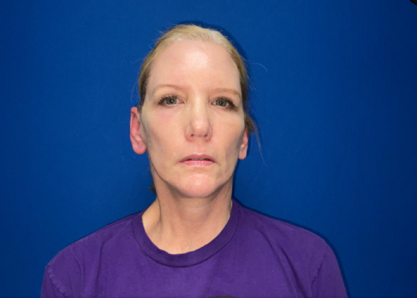 Facelift Case 19 - After