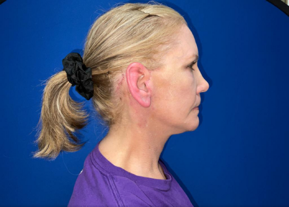 Facelift: Case 19 - After