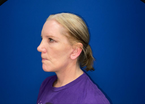 Facelift: Case 19 - After