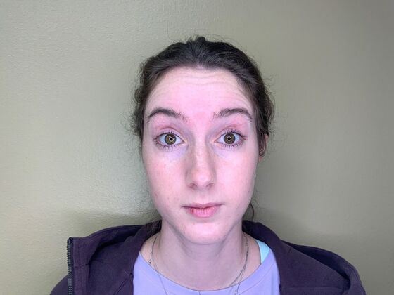 Botox® Cosmetic Case 1 - Before