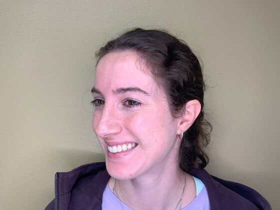 Botox® Cosmetic: Case 1 - Before