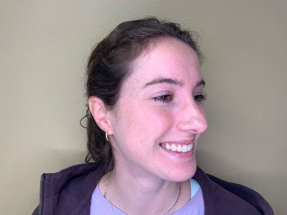 Botox® Cosmetic: Case 1 - Before