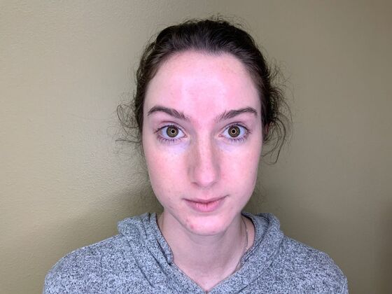 Botox® Cosmetic Case 1 - After