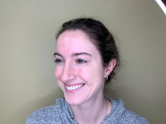 Botox® Cosmetic: Case 1 - After