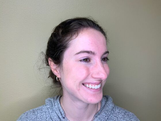 Botox® Cosmetic: Case 1 - After