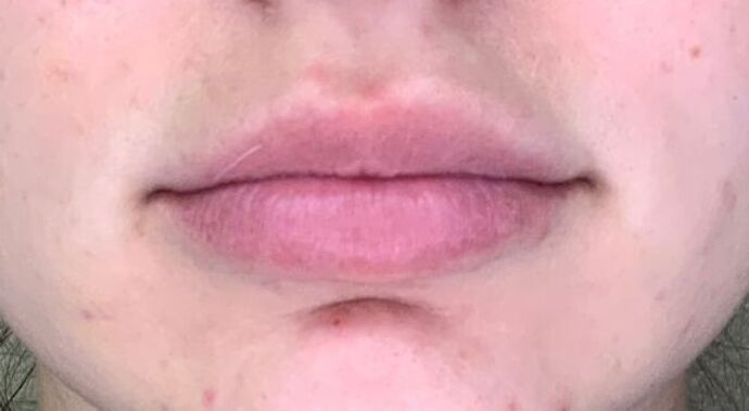 Filler Case 1 - Before