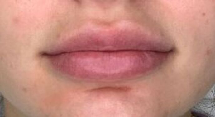 Filler Case 1 - After