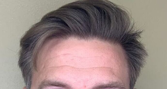 Botox® Cosmetic Case 2 - Before