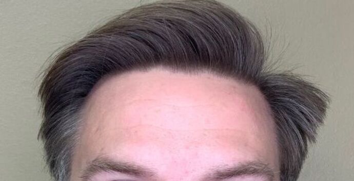 Botox® Cosmetic Case 2 - After