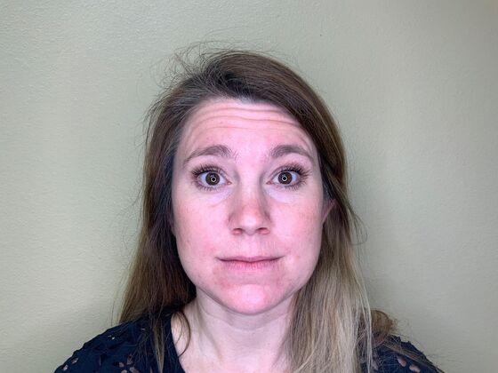 Botox® Cosmetic Case 3 - Before