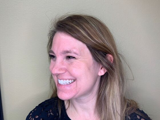 Botox® Cosmetic: Case 3 - Before