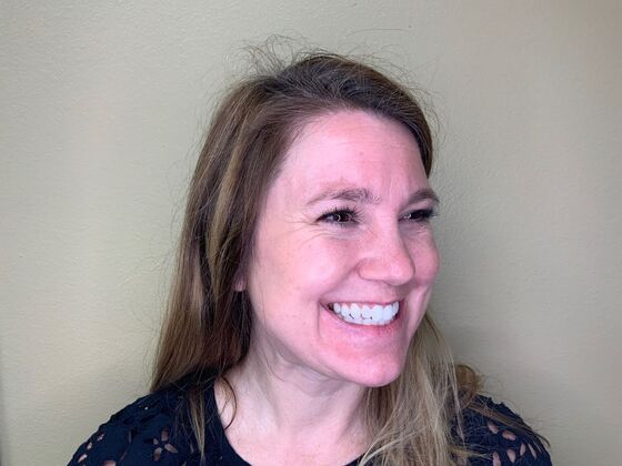 Botox® Cosmetic: Case 3 - Before