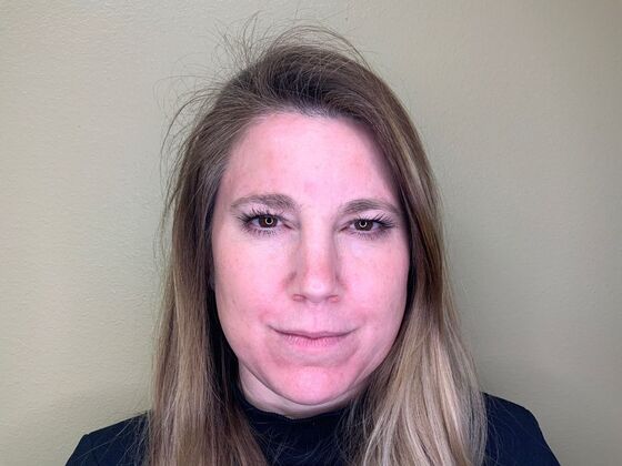 Botox® Cosmetic: Case 3 - After