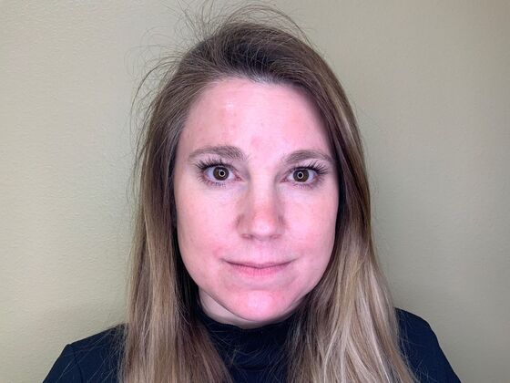 Botox® Cosmetic Case 3 - After