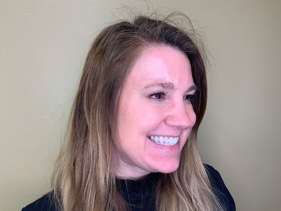 Botox® Cosmetic: Case 3 - After