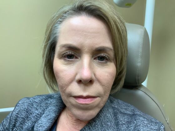 Botox® Cosmetic Case 4 - Before