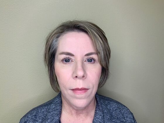 Botox® Cosmetic Case 4 - After