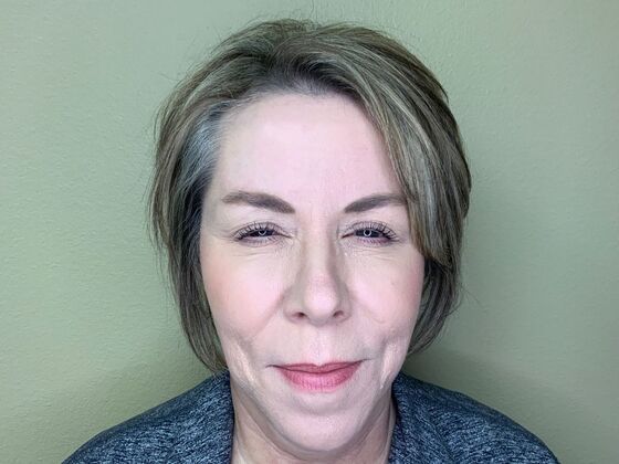 Botox® Cosmetic: Case 4 - Before