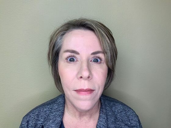 Botox® Cosmetic: Case 4 - After